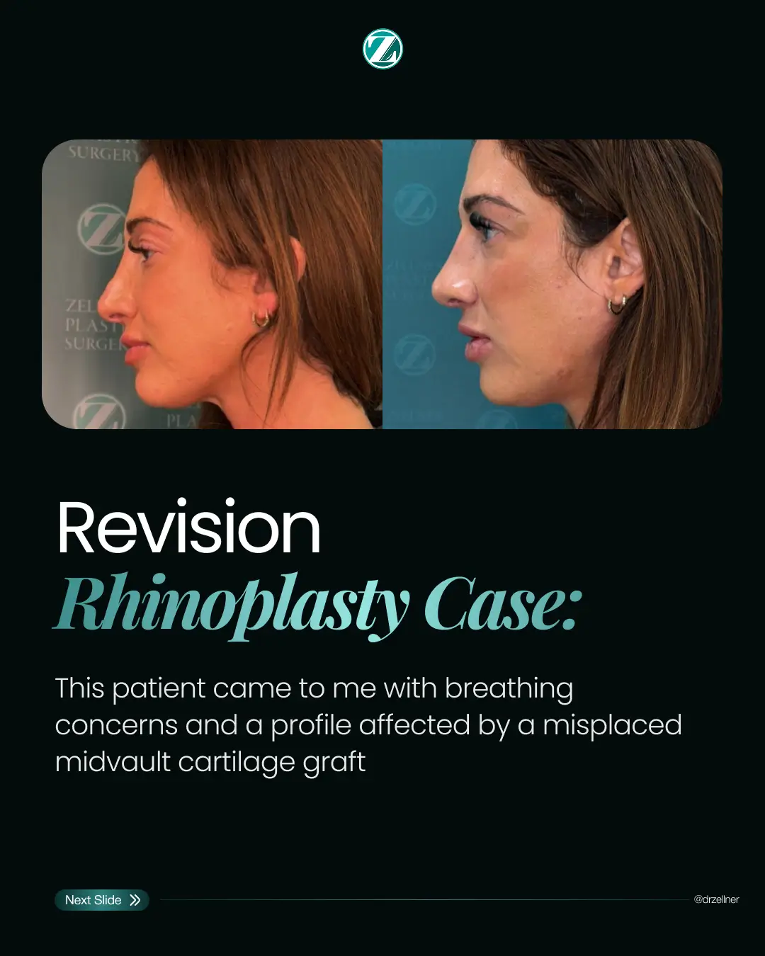 Card 1 - Carousel Rhinoplasty 2